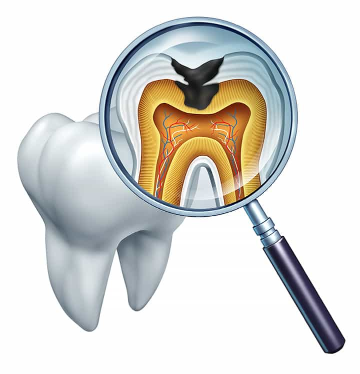 Root Canal Treatment in Cary, NC